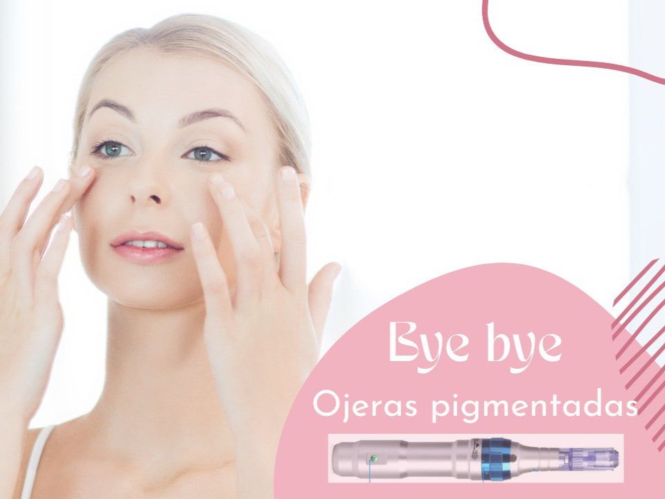 ojeras pigmentadas